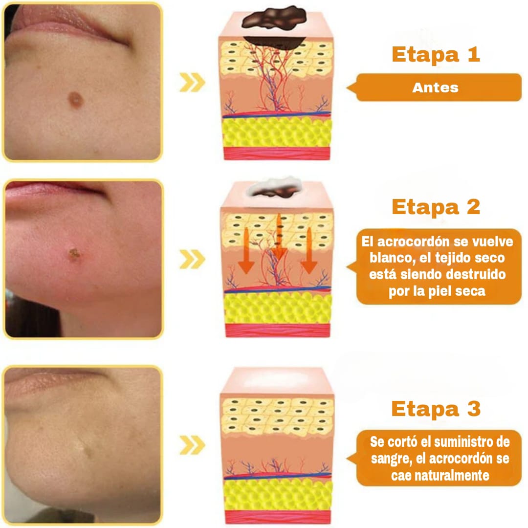 Aerosol contra el veneno de abeja